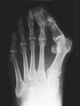 R&ouml;ngtenbild Hallux valgus